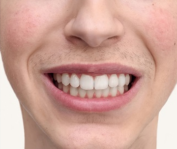 Smile Designing