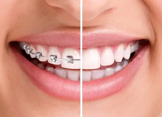 Smile Designing